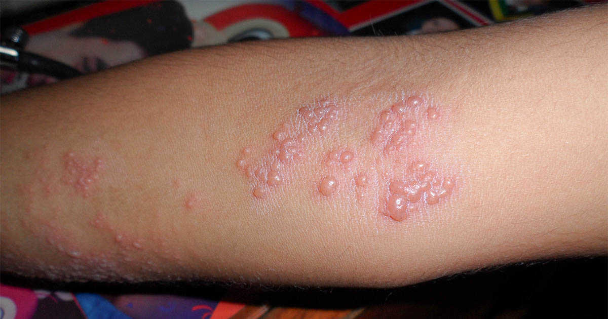 Herpes-zóster: doença pode causar dores intensas e complicações; vacinação ajuda na prevenção